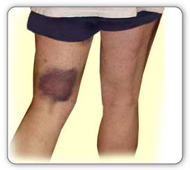 hamstring bruise