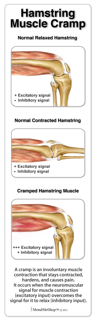 Hamstring Muscle Cramps