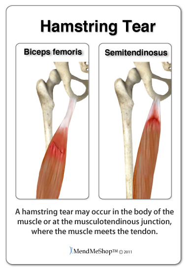 hamstring muscle tear may need surgery to repair the damage