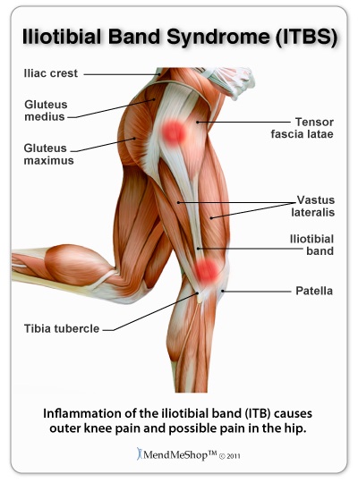 Iliotibial Band ITB Friction Syndrome Perth