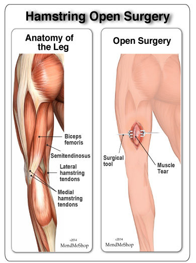 open hamstring surgery repair for leg pain
