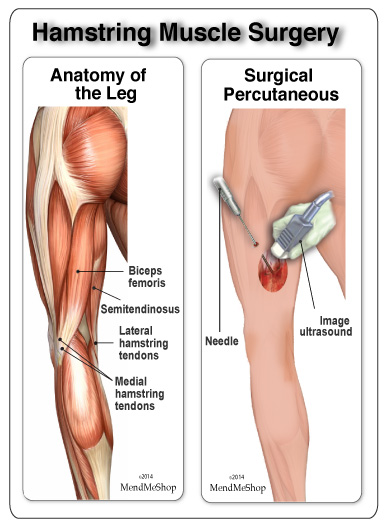 open muscle surgery repair on hamstring muscle