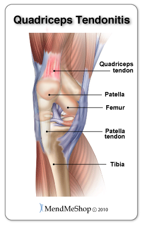 Quadriceps tendinitis - inflammation of the quadriceps tendon is caused by tiny tears that are not given the proper rest time to heal.