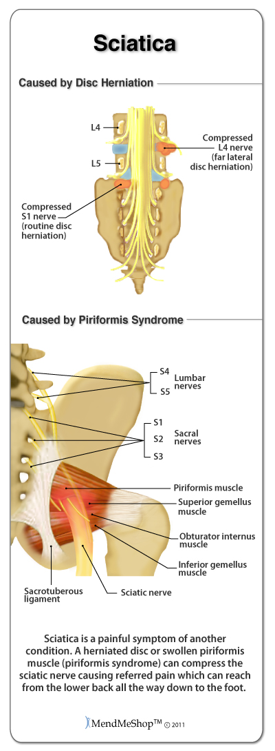Pinching of a sciatic nerve can be caused by disc herniation and piriformis syndrome.