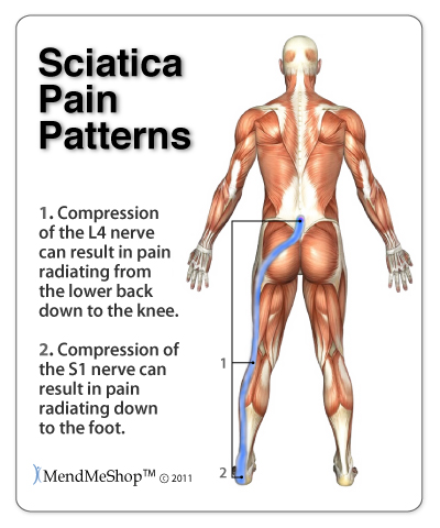 Pinching of a sciatic nerve can cause lower back and hip pain and reach down the leg to the foot.